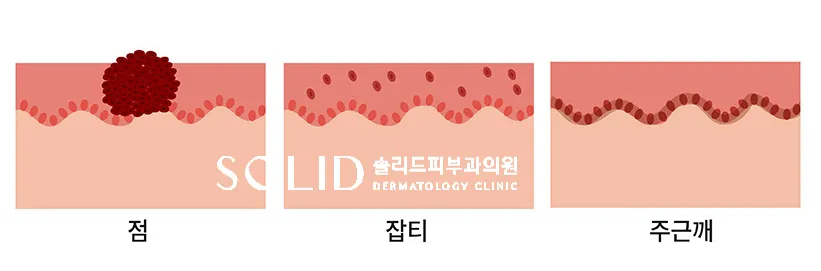 점·잡티·주근깨의 색소가 위치한 피부층을 비교한 단면 설명 이미지