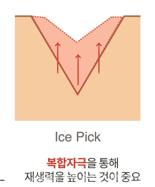 아이스픽흉터를 복합 자극으로 재생시키는 원리를 나타낸 단면 설명 이미지