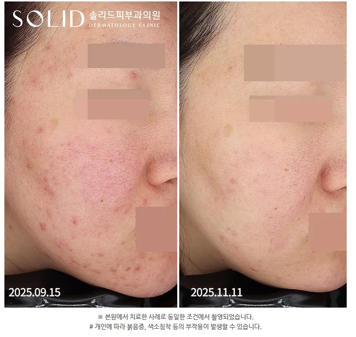 여드름·홍조 복합치료 4회 전후 우측 볼 임상사진(본원 치료·동일 조건 촬영 안내 포함), 개인차 있음
