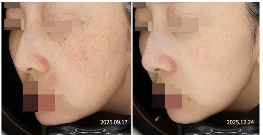 기미 복합치료 5회 전(2025.09.17)과 후(2025.12.24) 좌측 45도 볼·코 임상사진, 개인차 있음