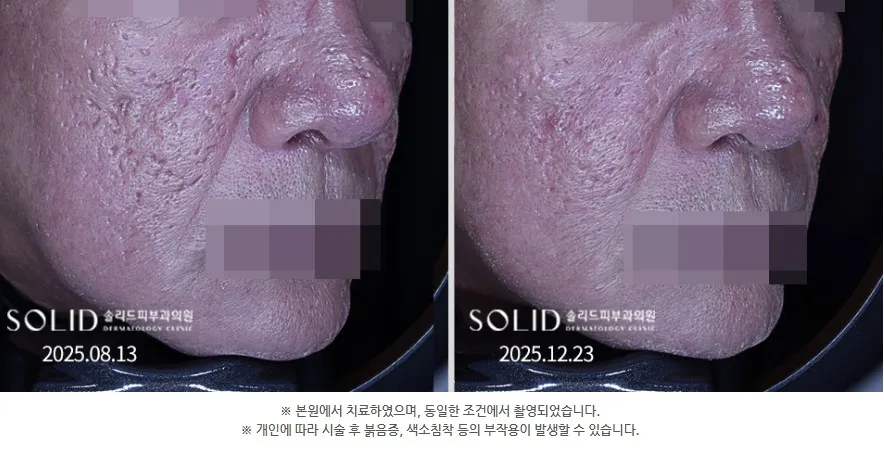 박스카 흉터 복합치료 전후 우측 45도 볼 임상사진(본원 치료·동일 조건 촬영 안내 포함), 개인차 있음
