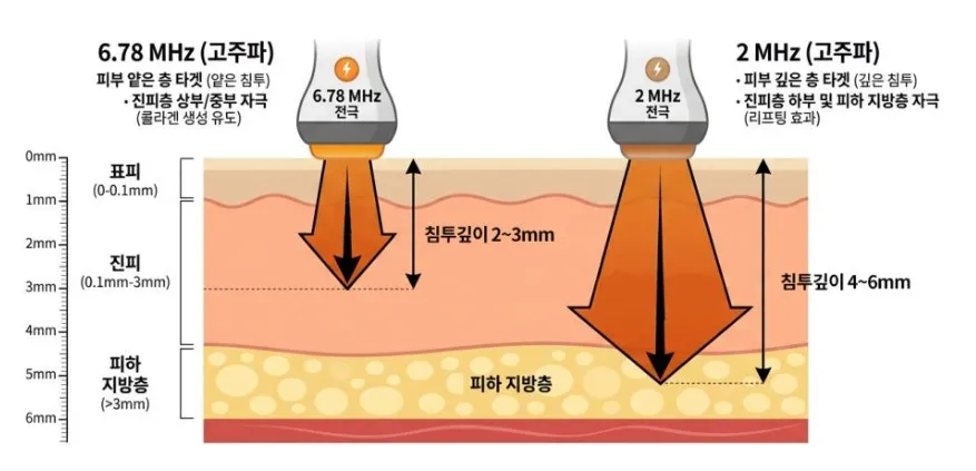 6.78MHz 고주파는 진피 23mm, 2MHz 고주파는 피하 지방층 46mm까지 침투하는 깊이 차이를 나타낸 피부 단면 설명 이미지