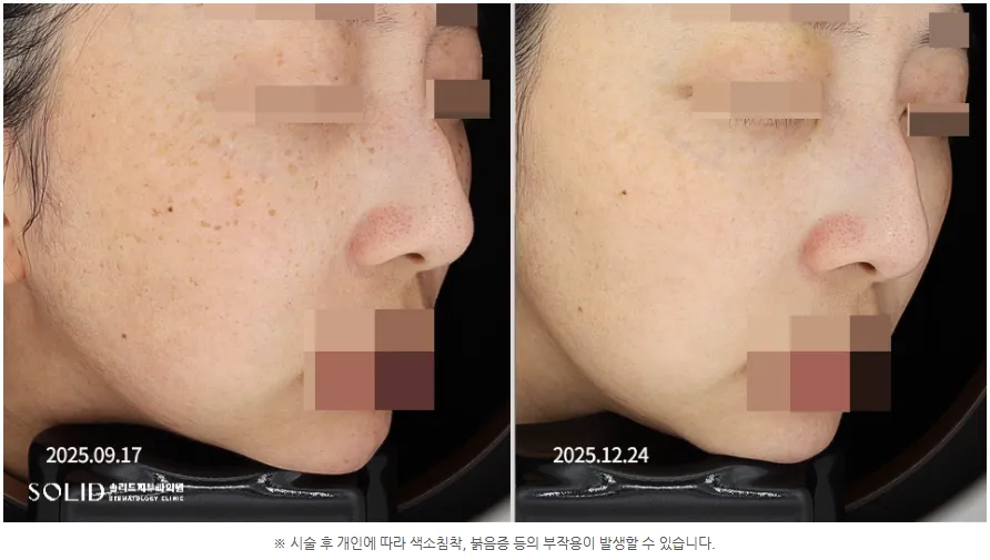 치료 전후 눈 주변 흑자증 부위를 확대한 임상사진, 개인차 있음