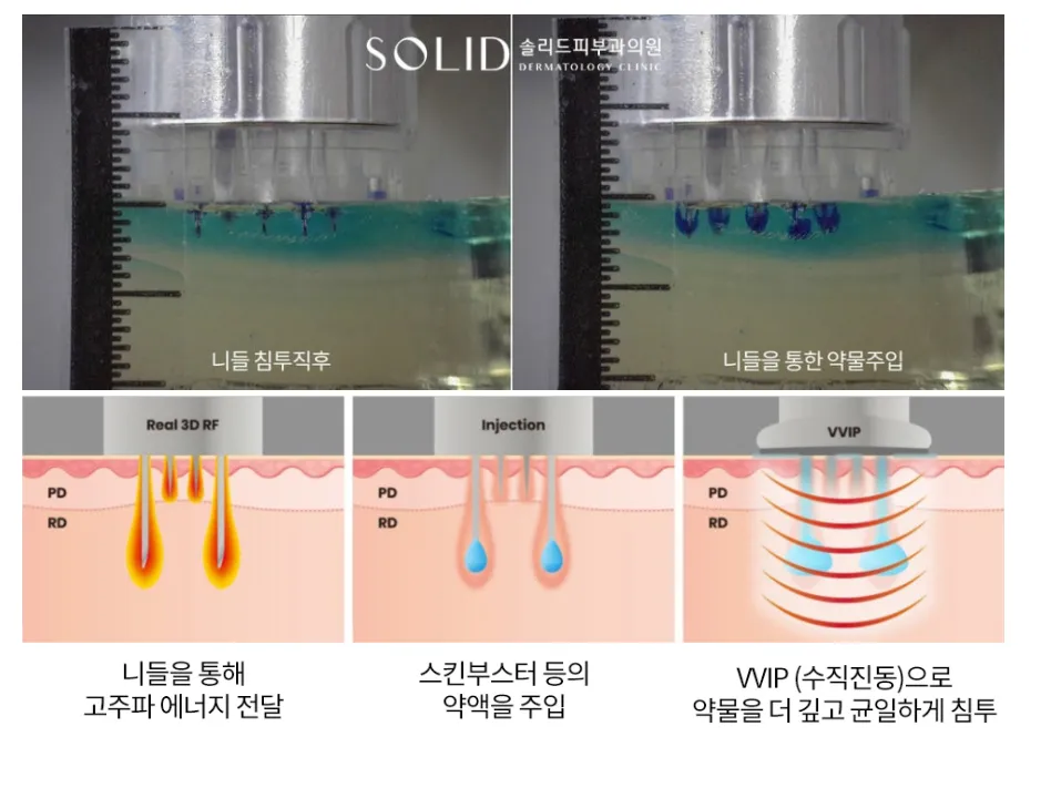 더블타이트 니들 침투와 약물 주입 실험 사진, 그리고 Real 3D RF·Injection·VVIP 수직진동 방식을 나타낸 설명 이미지