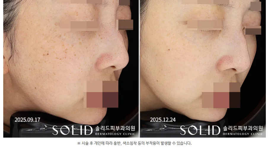기미 복합치료 5회 전후 우측 45도 볼·코 임상사진, 개인차 있음