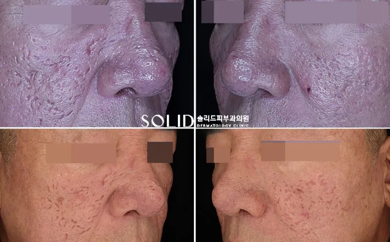 치료 전 양볼·코·나비존의 박스카 흉터와 울퉁불퉁한 피부 변형을 여러 각도에서 촬영한 임상사진, 개인차 있음