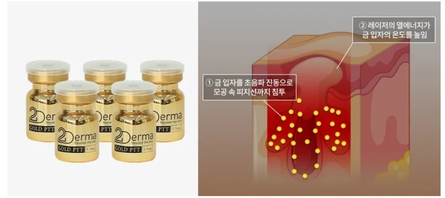 골드PTT 제품 바이알과 금 입자가 초음파 진동으로 피지선까지 침투한 뒤 레이저 열로 가열되는 원리를 나타낸 설명 이미지