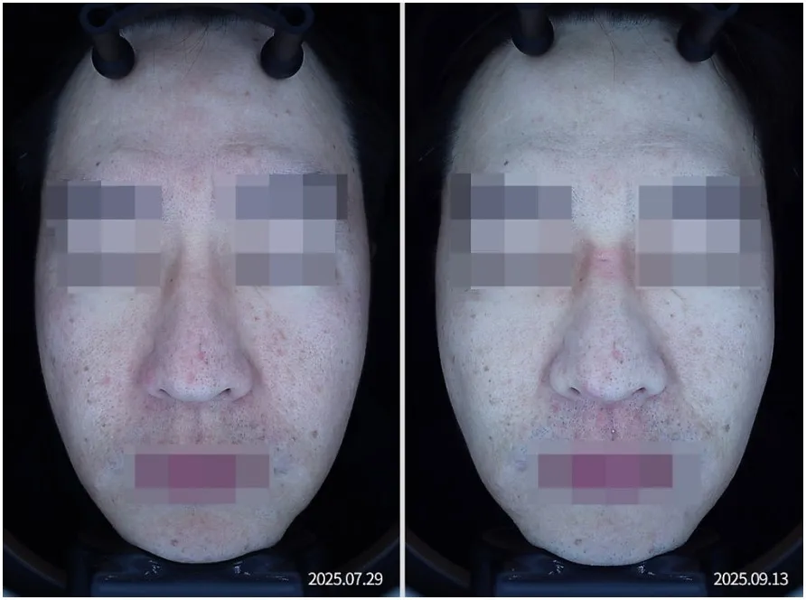 포텐자 1회 치료 전후 좌측 볼 부위 홍조·모공 임상사진, 개인차 있음