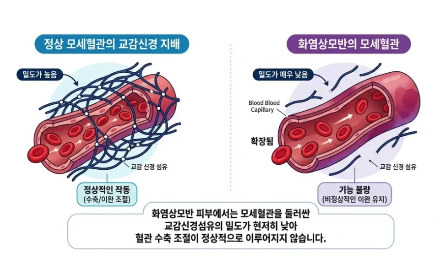 교감신경섬유 밀도가 높은 정상 모세혈관과 밀도가 매우 낮아 확장된 채 유지되는 화염상모반 모세혈관을 비교한 설명 이미지