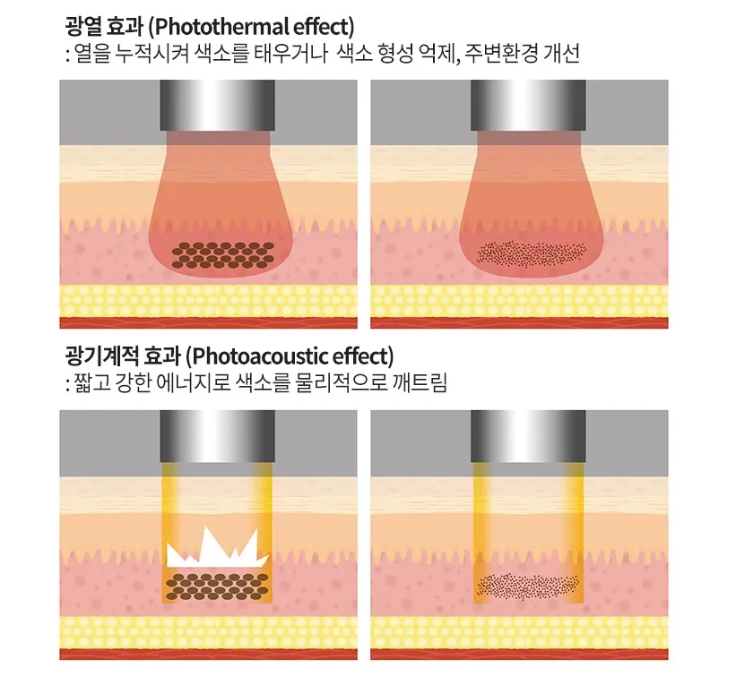 열을 누적시켜 색소를 태우는 광열 효과와 짧고 강한 에너지로 색소를 물리적으로 깨트리는 광기계적 효과를 비교한 설명 이미지