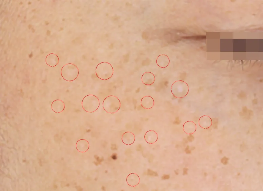 치료 전 광대 주변 피부를 확대해 흰색 점처럼 보이는 저색소침착을 표시한 임상사진, 개인차 있음