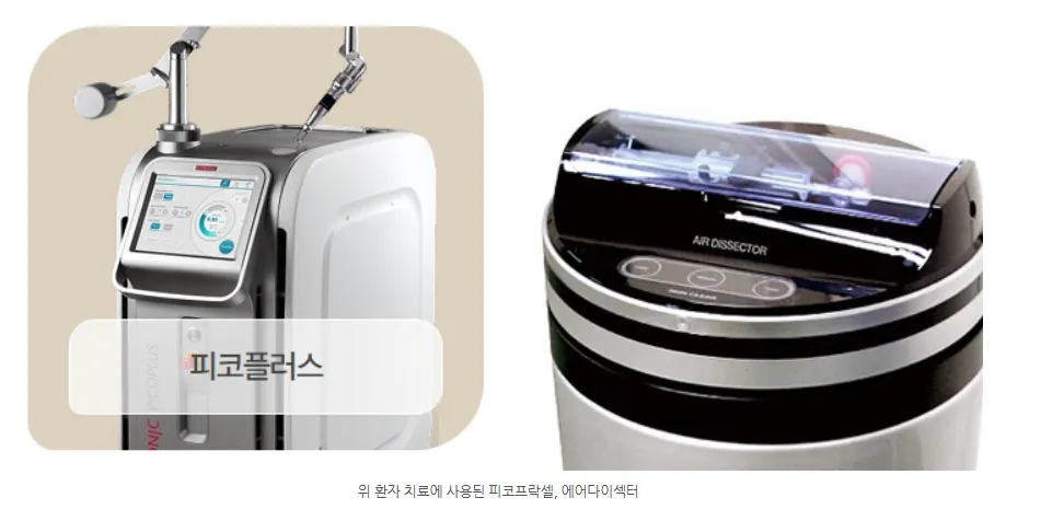 이 환자 치료에 사용된 피코플러스(피코프락셀)와 에어다이섹터 장비 이미지