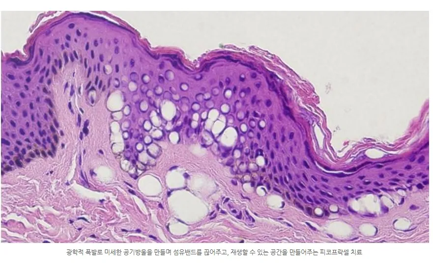 피코프락셀의 광학적 폭발로 표피·진피에 미세한 공기방울이 생긴 피부 조직 현미경 사진