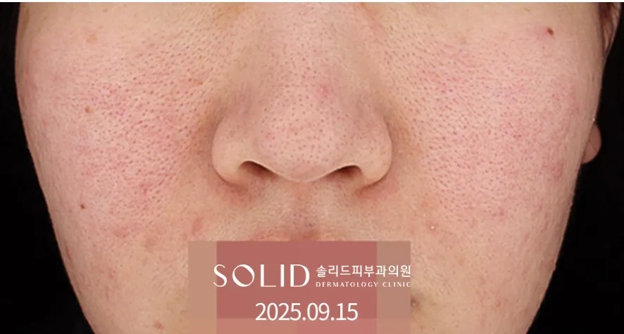 여드름·주사피부염 치료 전(2025.09.15) 얼굴 정면 임상사진, 개인차 있음