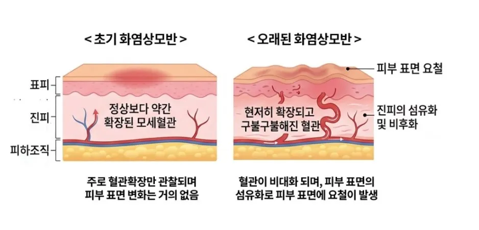 혈관 확장만 있는 초기 화염상모반과 혈관이 비대해지고 진피가 섬유화되어 표면에 요철이 생긴 오래된 화염상모반을 비교한 단면 설명 이미지