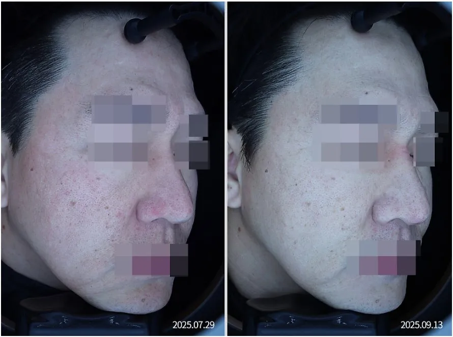 포텐자 1회 치료 전후 우측 볼 부위 홍조·모공 임상사진, 개인차 있음