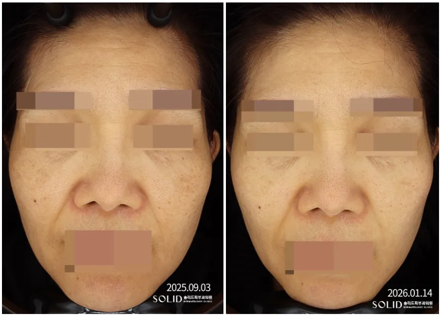 기미 복합치료 9회 전(2025.09.03)과 후(2026.01.14) 얼굴 정면 임상사진, 개인차 있음