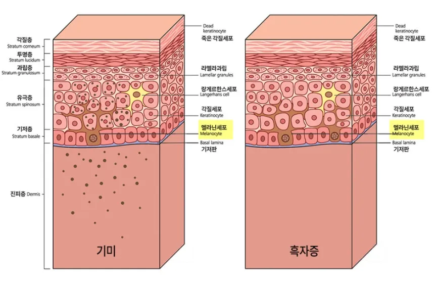 기미와 군집성 흑자증에서 멜라닌 색소·멜라닌 세포가 분포하는 피부층을 나타낸 설명 이미지