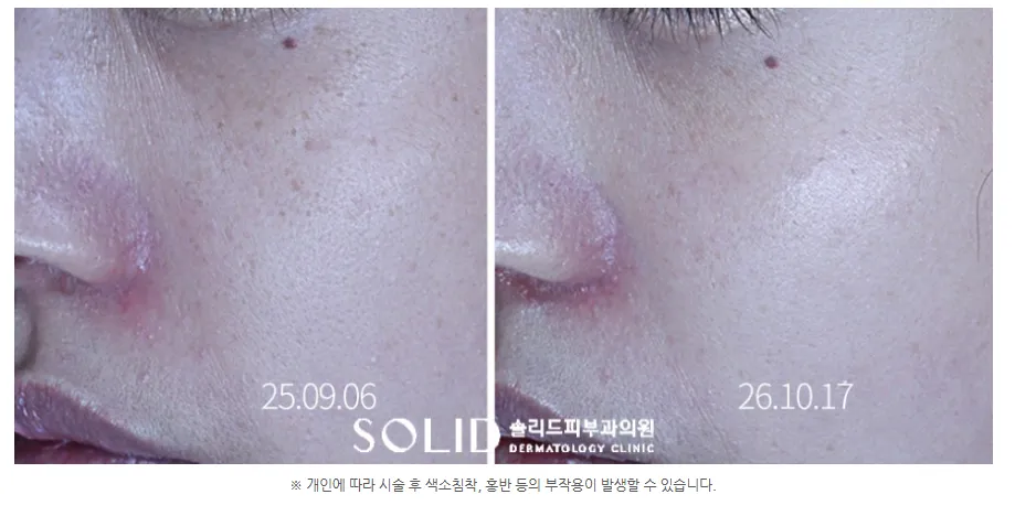 치료 전후 코옆·볼 부위를 확대해 잡티와 붉은기 변화를 비교한 임상사진, 개인차 있음