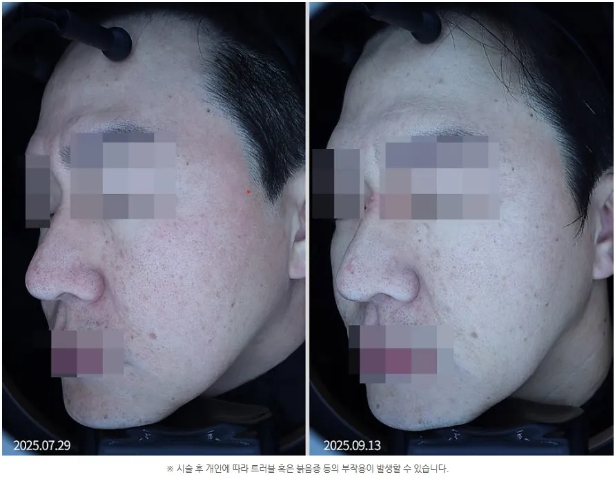 포텐자 1회 치료 전후 코·나비존 모공 확대 임상사진, 개인차 있음