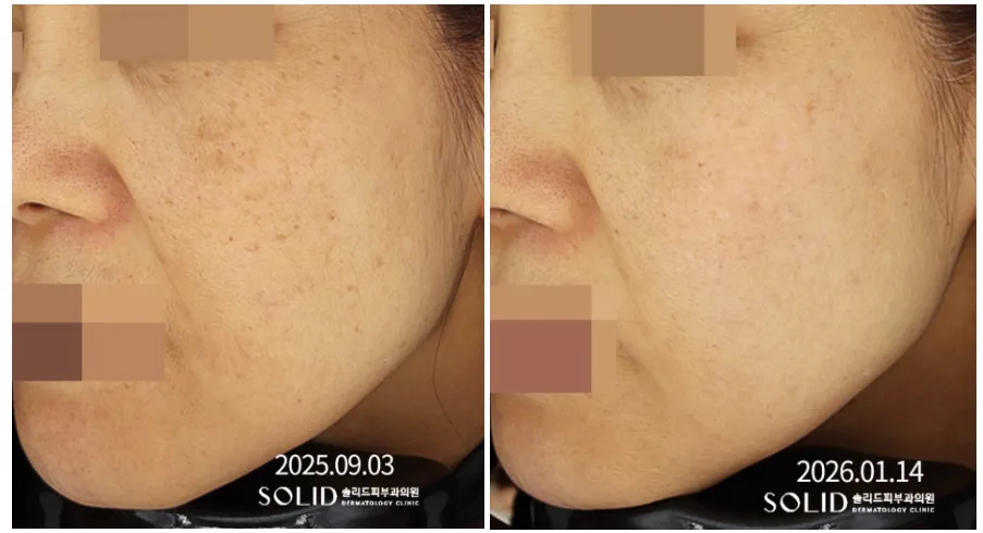 기미 복합치료 9회 전후 좌측 볼·광대 임상사진, 개인차 있음