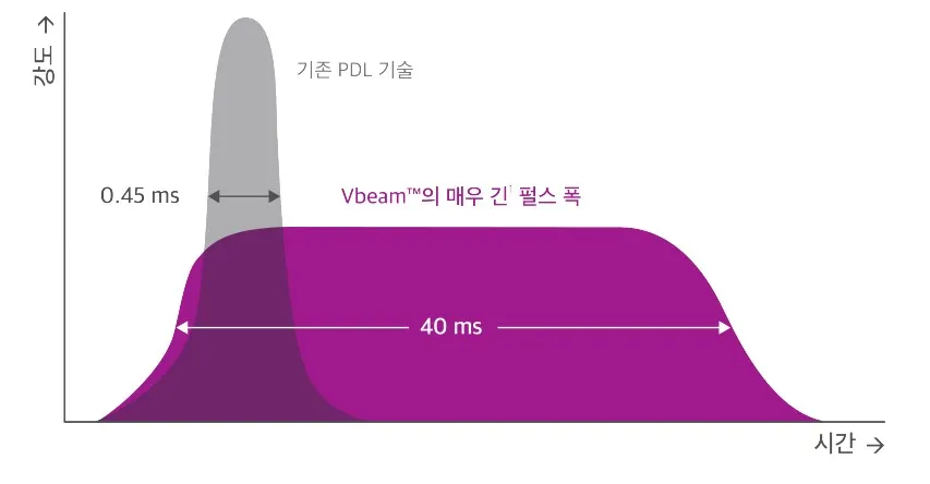 기존 PDL의 0.45ms 펄스와 브이빔의 40ms 긴 펄스폭을 비교한 그래프 이미지