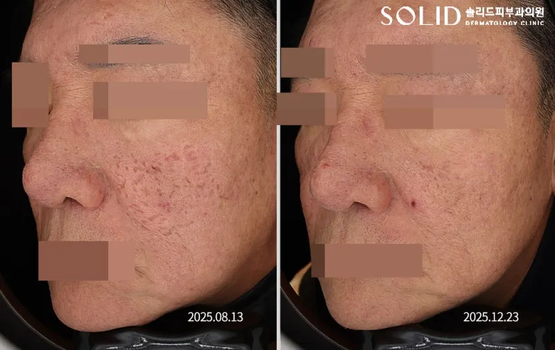 복합흉터치료 5회와 쥬베룩 3회 전(2025.08.13)과 후(2025.12.23) 좌측 볼 임상사진, 개인차 있음