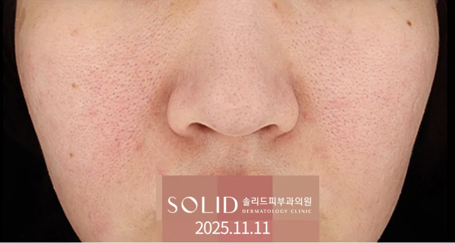 여드름·주사피부염 4회 치료 후(2025.11.11) 얼굴 정면 임상사진, 개인차 있음