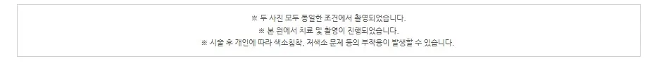 두 사진 모두 동일한 조건에서 촬영되었고 본원에서 치료·촬영이 진행되었으며 개인에 따라 색소침착·저색소 문제 등의 부작용이 발생할 수 있다는 안내 문구 이미지