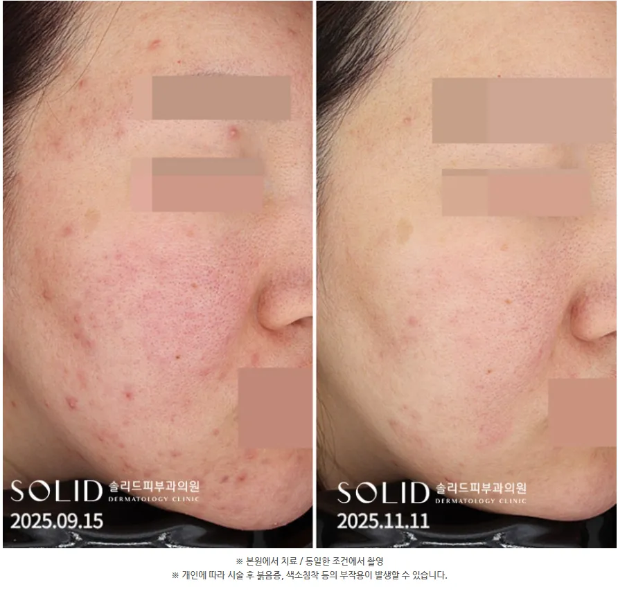 여드름·주사피부염 4회 치료 전후 좌측 볼 임상사진(본원 치료·동일 조건 촬영 안내 포함), 개인차 있음