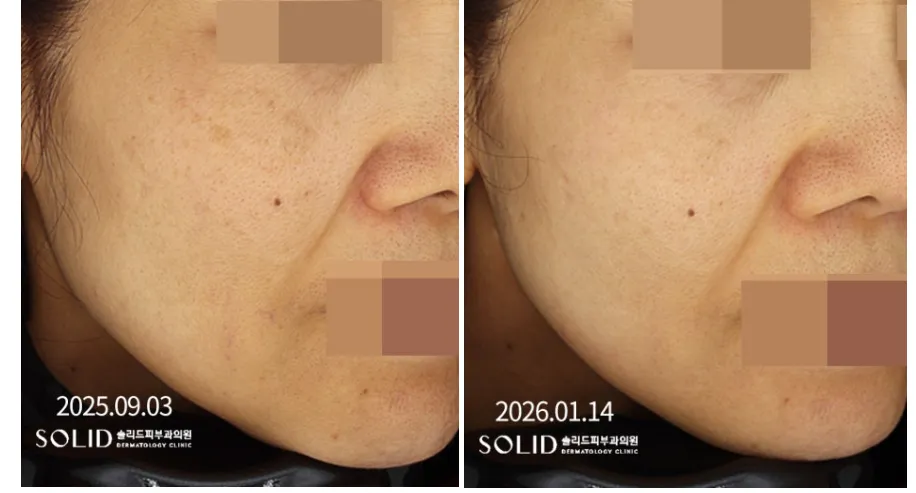 기미 복합치료 9회 전후 우측 볼·광대 임상사진, 개인차 있음