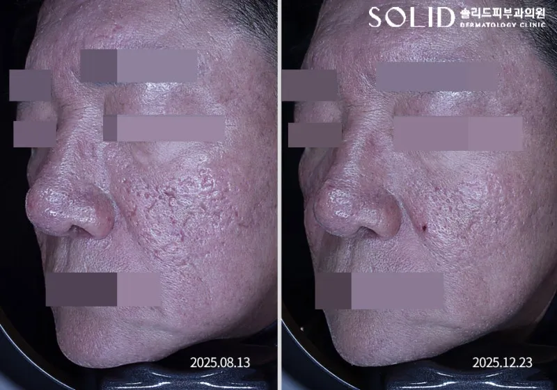 복합흉터치료 5회와 쥬베룩 3회 전후 좌측 45도 볼·코 임상사진, 개인차 있음