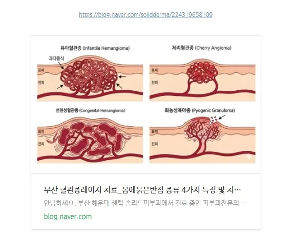 혈관종 4가지 종류를 다룬 블로그 글(부산 혈관종레이저 치료_몸에붉은반점 종류 4가지 특징 및 치료 방법)의 링크 미리보기 이미지