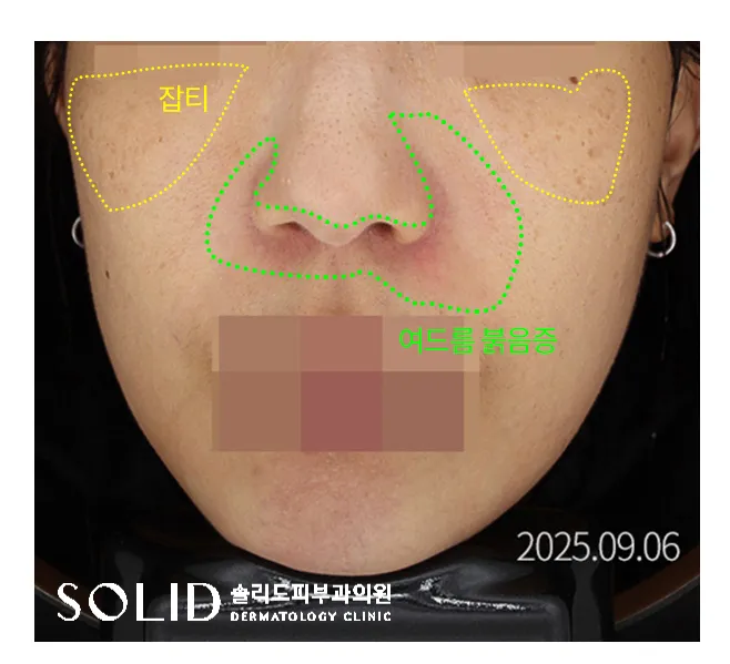 치료 전 얼굴 정면 사진에 잡티 부위(광대)와 여드름 붉음증 부위(코 주변)를 표시한 임상사진, 개인차 있음