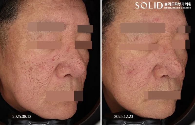 복합흉터치료 5회와 쥬베룩 3회 전후 우측 볼 임상사진, 개인차 있음