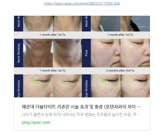 더블타이트 리쥬란 시술 효과와 통증을 다룬 블로그 글의 링크 미리보기 이미지(목주름·모공·눈가주름 사례 썸네일 포함)