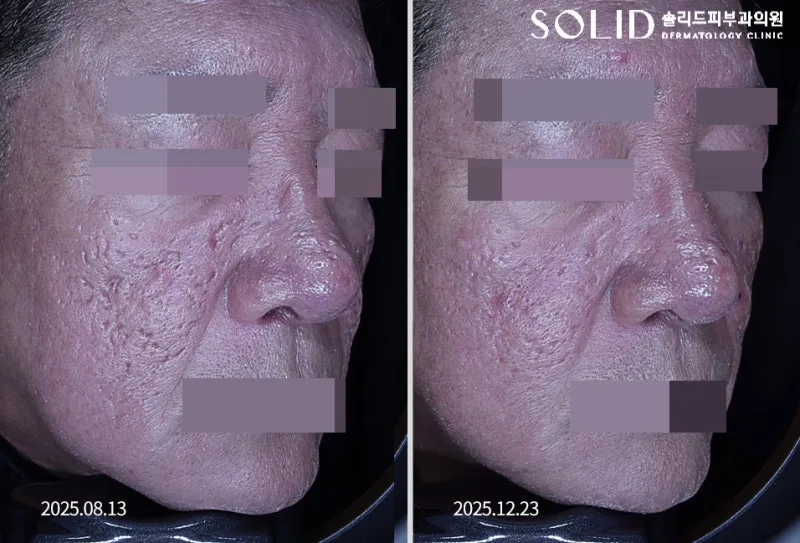 복합흉터치료 5회와 쥬베룩 3회 전후 우측 45도 볼·코 임상사진, 개인차 있음