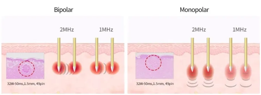 기존 니들프락셀의 단일 펄스와 포텐자 서브펄스 방식의 에너지 전달 차이를 나타낸 설명 이미지