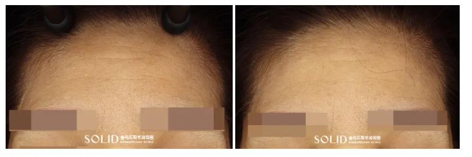 기미 복합치료 9회 전후 이마 주름 임상사진, 개인차 있음