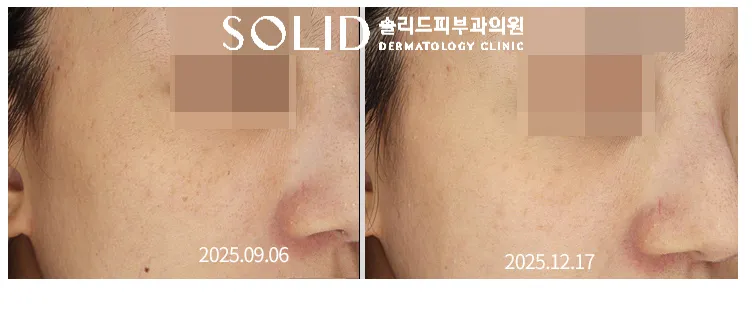 치료 전후 눈밑·광대 부위 잡티와 피부톤 변화를 비교한 임상사진, 개인차 있음
